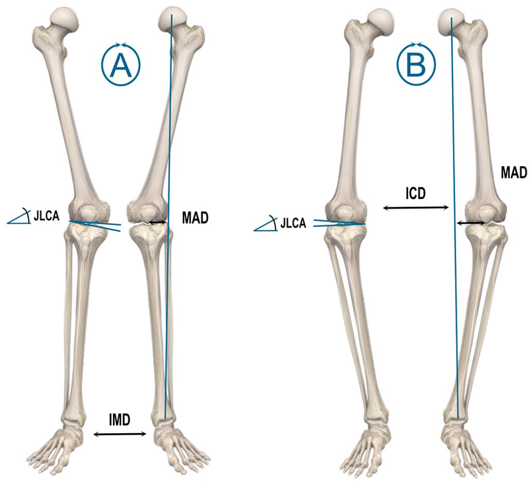 varum vs valgus